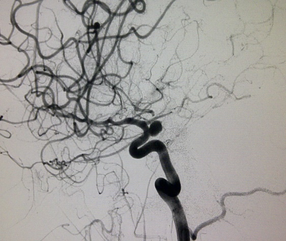 RICA precoiled