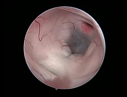 Endoscopic Brain Surgery