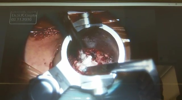 Spine Surgery