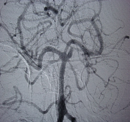 Preop SCA Aneurysm