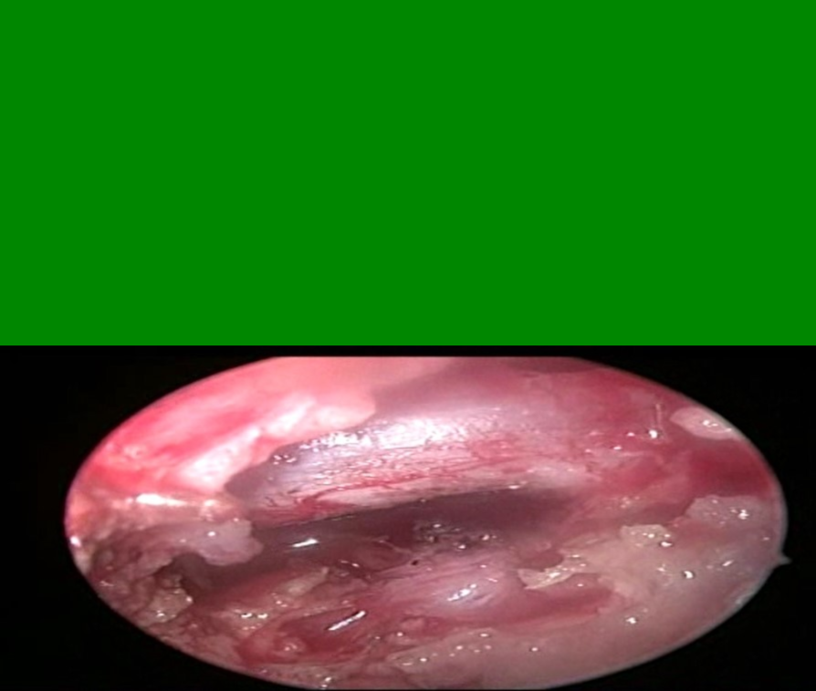 Spine Surgery